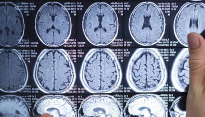 La guía de accidentes cerebrovasculares de EE.UU. recoge por primera vez el ictus pediátrico