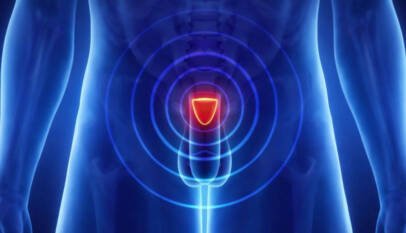 Un nuevo dispositivo de terapia láser logra controlar el cáncer de próstata con menos secuelas