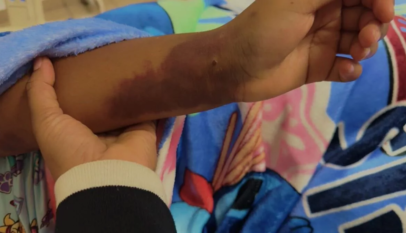 Familia de niña pide ayuda urgente para acceder a tratamiento de RD.7 millones