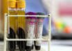 Las señales de alerta genéticas del cáncer de sangre pueden aparecer años antes