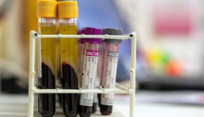 Las señales de alerta genéticas del cáncer de sangre pueden aparecer años antes