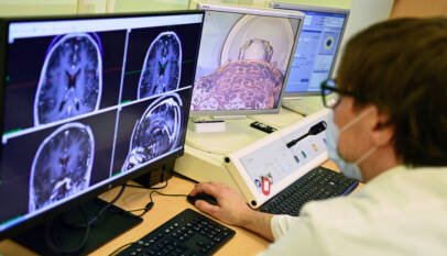 Nanopartículas iluminan el glioblastoma y atacan las células que la cirugía no logra eliminar